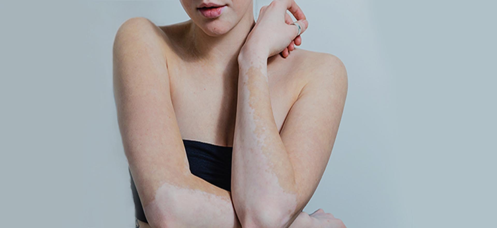 Laser skin treatment in Hazratganj Lucknow
