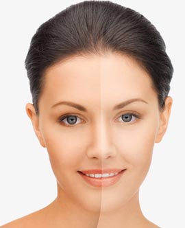 Botox treatment in Hazratganj Lucknow
