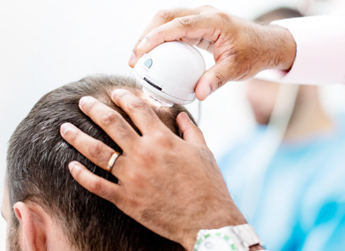 Hair transplant in Hazratganj Lucknow