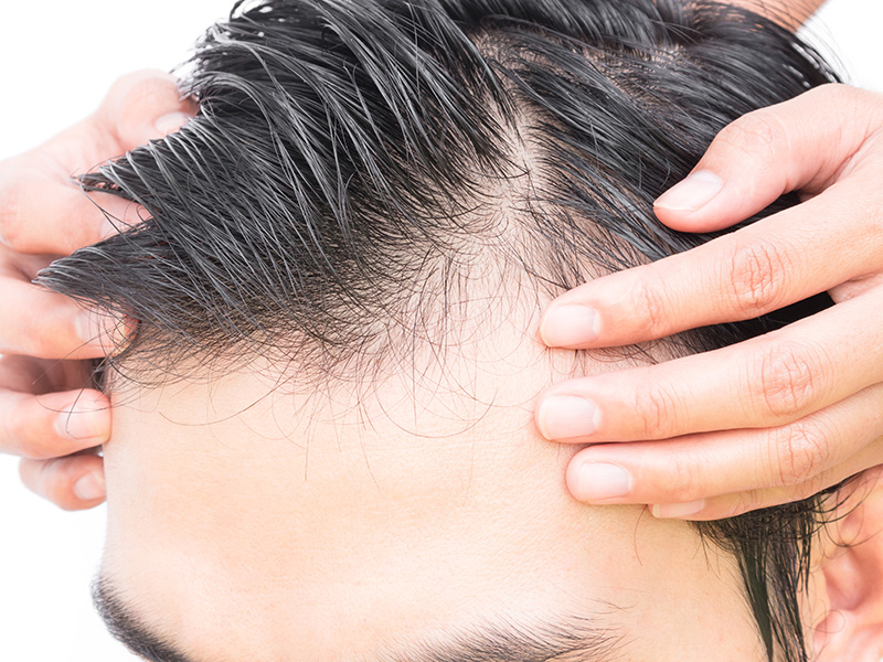 Hair transplant in Hazratganj Lucknow