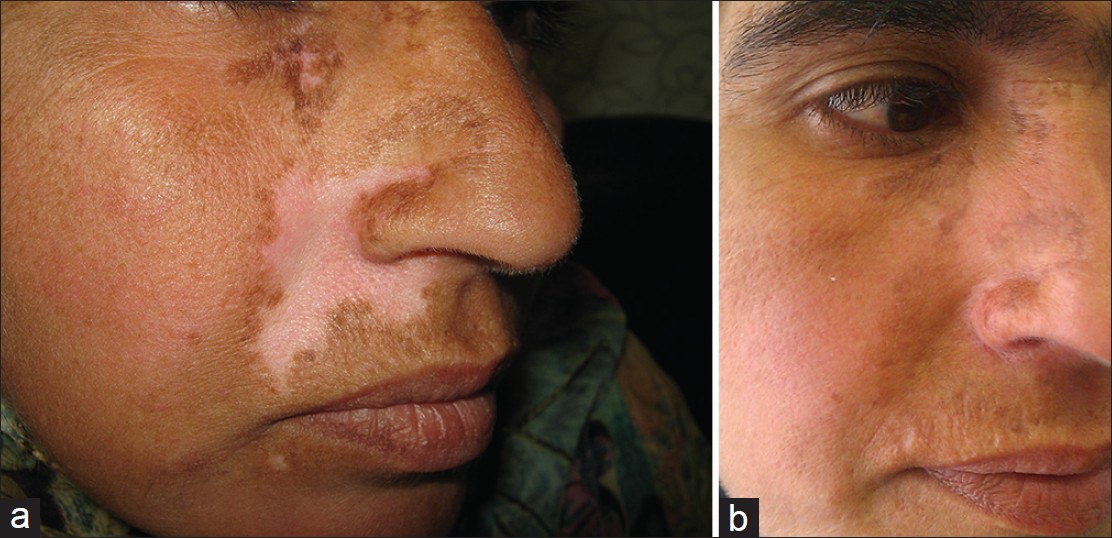 Filler treatment in Hazratganj Lucknow