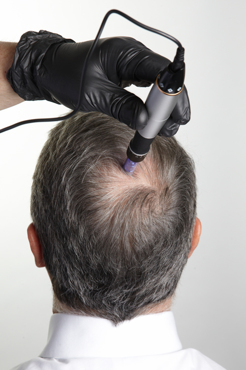 Hair transplant in Hazratganj Lucknow