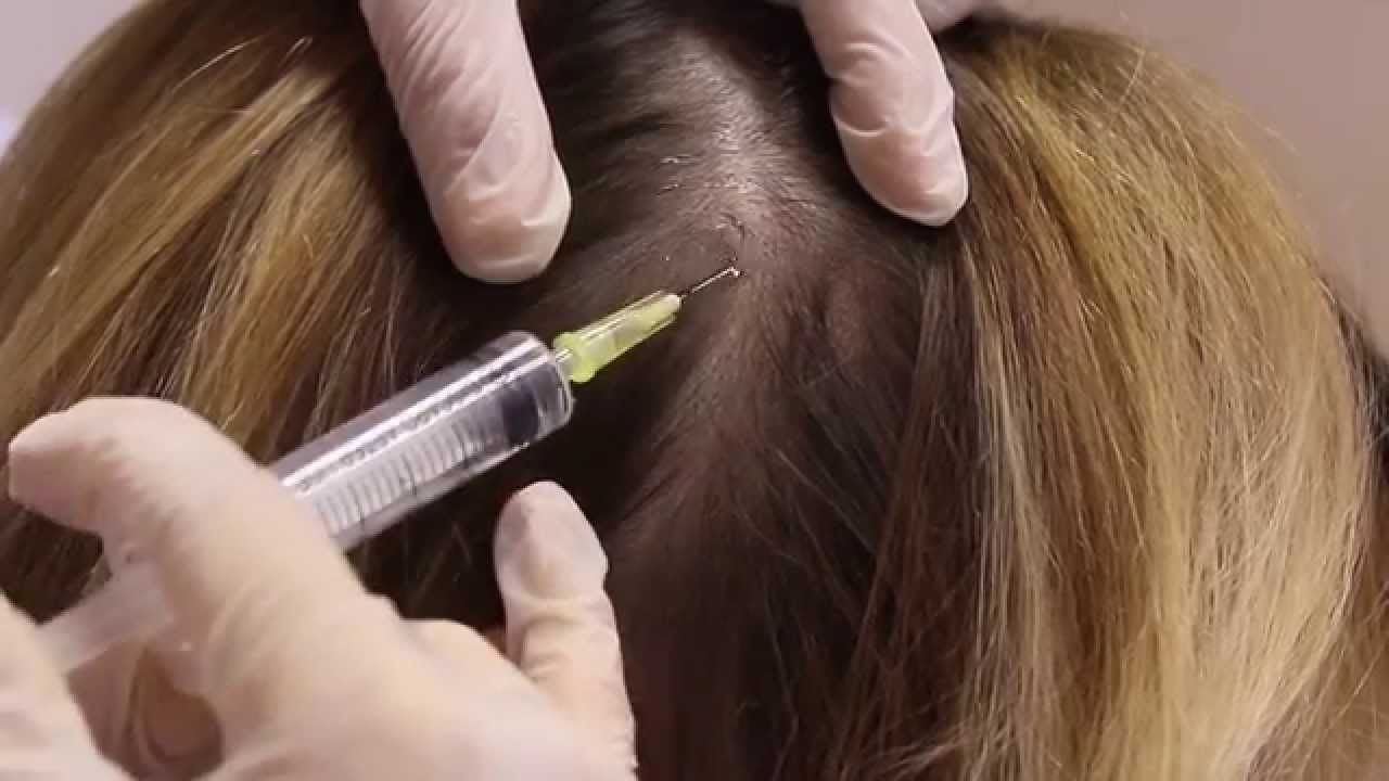 Hair transplant in Hazratganj Lucknow