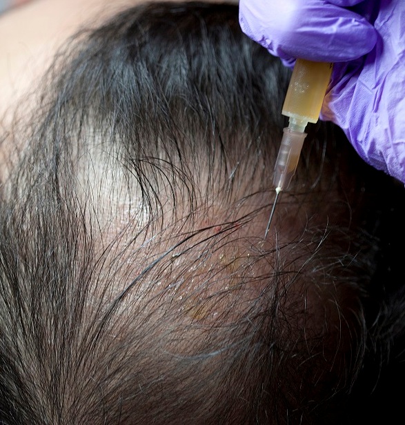 Laser hair reduction in Hazratganj Lucknow