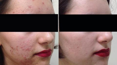 Laser hair reduction in Hazratganj Lucknow