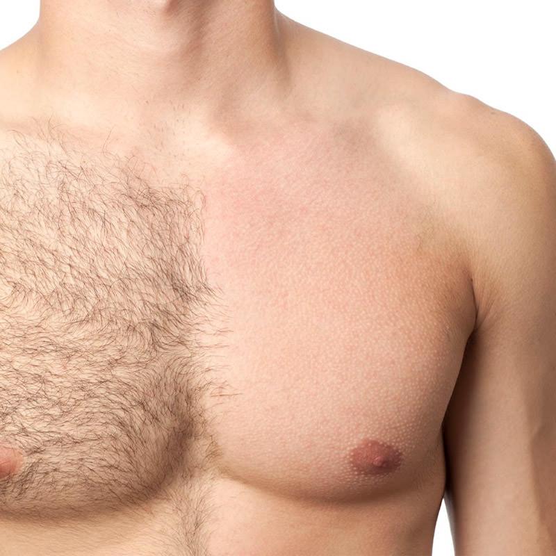 Full Body Laser hair Removal in lucknow