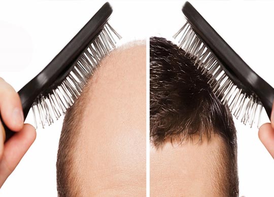 Hair transplant in Hazratganj Lucknow