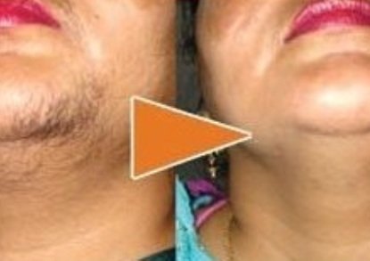 Laser hair Removal In Lucknow - Derma klinic Laser hair Removal In Lucknow - Derma klinic