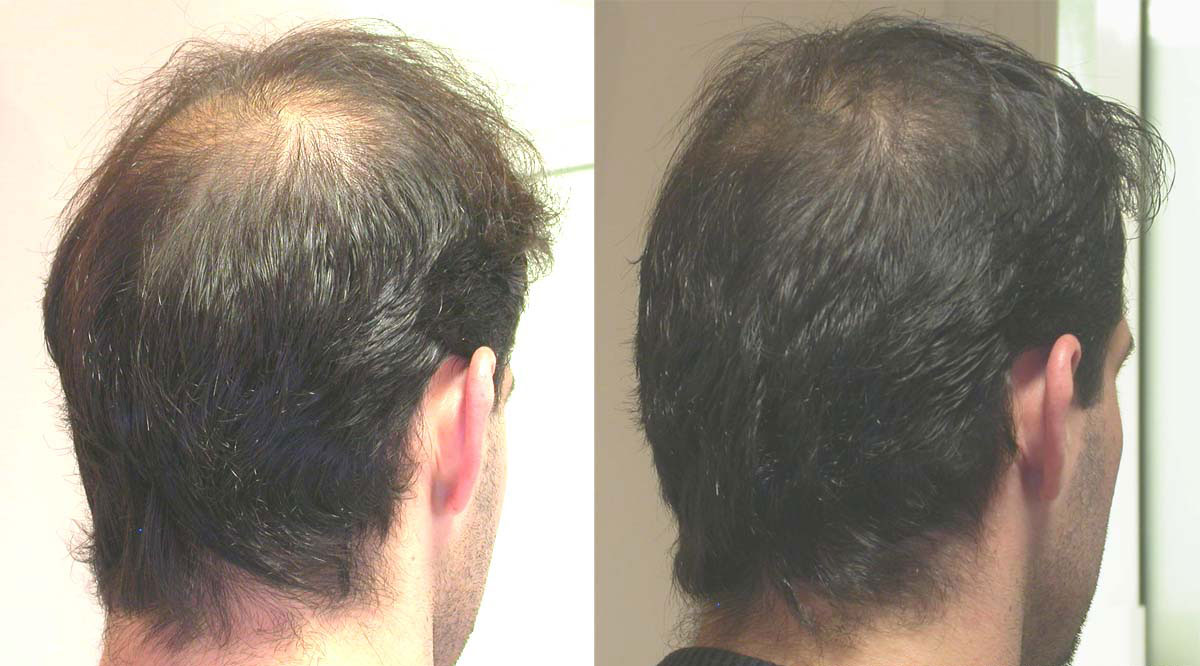 PRP Treatment In Lucknow