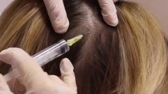 Laser hair reduction in Hazratganj Lucknow