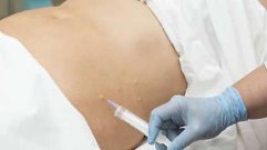 Laser skin treatment in Hazratganj Lucknow