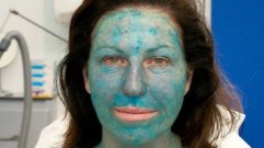 Botox treatment in Hazratganj Lucknow